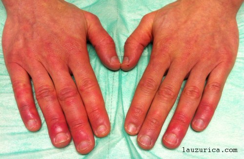 Sabañones en todos los dedos de la manos.