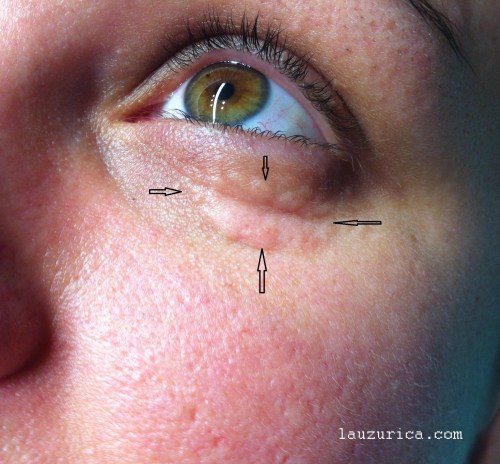 Siringomas agrupados en forma de placa