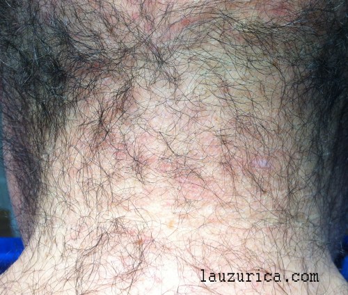 Psoriasis de nuca