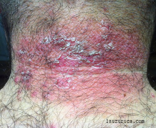 Lesiones eritematodescamativas de nuca. ¿Psoriasis?