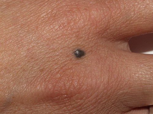 Localización típica de nevus azul