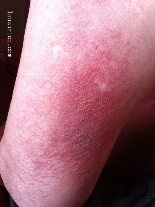 Placa rojo-violácea con reticulado periférico