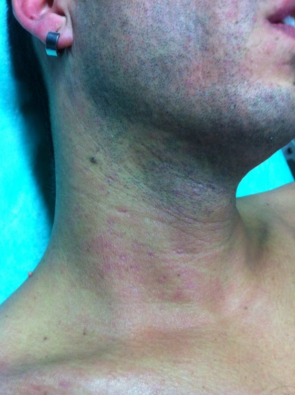 Desaparición de las lesiones con tratamiento antivírico