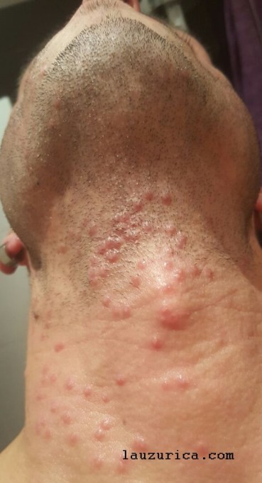 Pápulas vesiculosas en el inicio