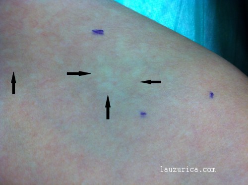 Máculas blanquecinas agrupadas en brazo