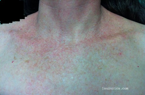 Gran dilatación vascular en escote