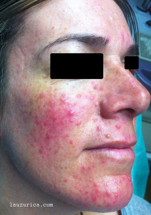 Otro brote distinto con más componente eritematoso