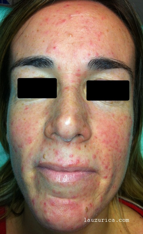 Rosácea papulo-pustulosa