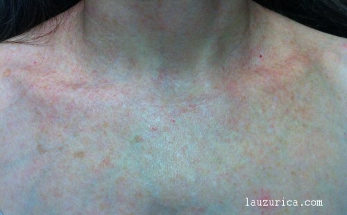 Rosácea en escote tras 2 sesiones de Luz Pulsada (SWT)