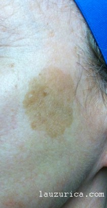 Gran léntigo solar en la cara