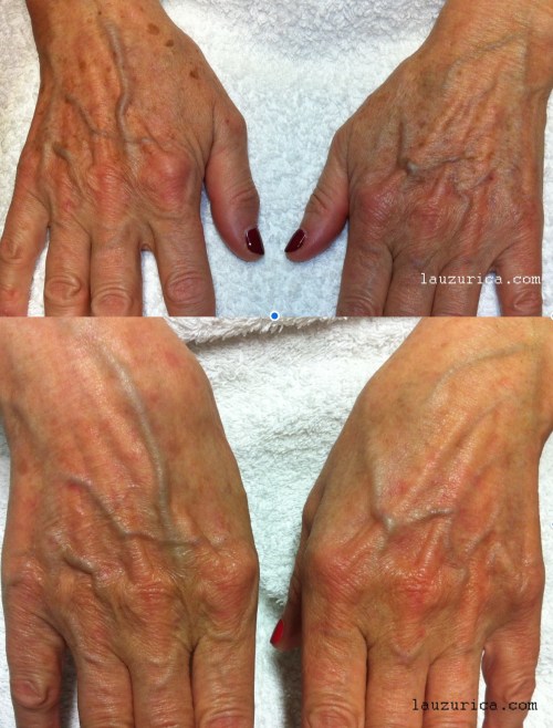 Aumento de luminosidad y mejoría de léntigos solares en dorso de manos tras IPL (SWT)