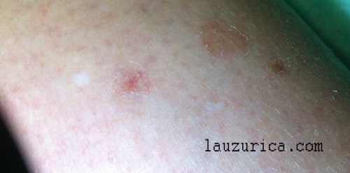 Poroqueratosis, detalle de color.