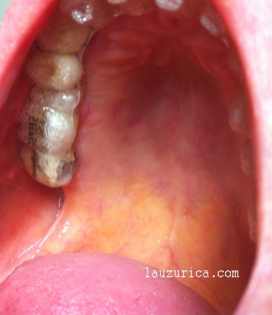 Aftas curadas sin cicatriz