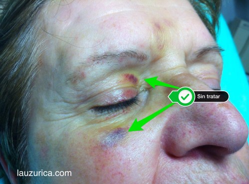 Aspecto a los 3 días de aplicar luz pulsada intensa.