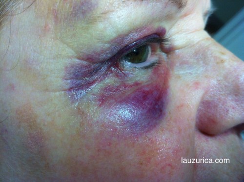 Hematoma periocular 2 días despues del traumatismo