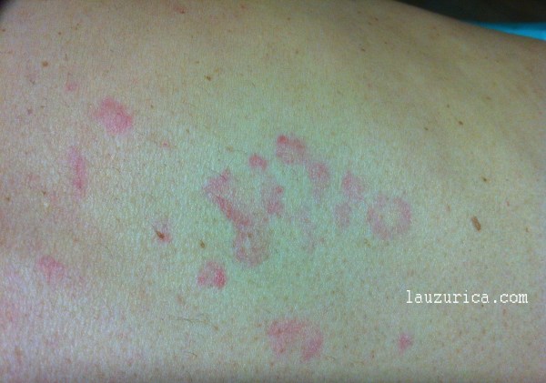 Habones en tronco provocados por temperatura ambiente