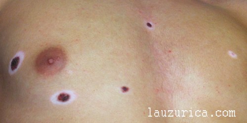 Paciente con múltiples nevus de Sutton (aprox. 15)