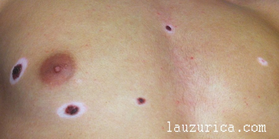 Paciente con múltiples nevus de Sutton (aprox. 15)