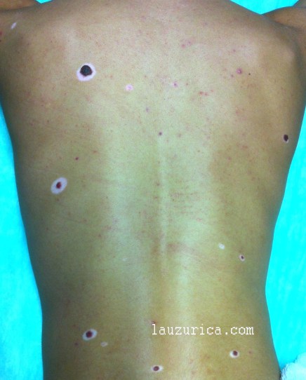 Paciente con múltiples nevus de Sutton