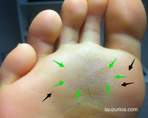 Queratólisis punctata en antepie